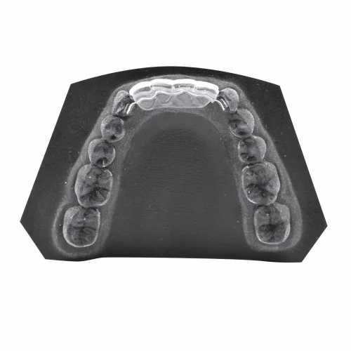 Bonded Lingual Retainer Mask